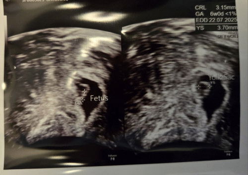 6 week scan: Comparing this pregnancy to my last pregnancy that ended in MC