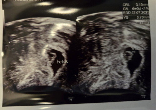 6 week scan: Comparing this pregnancy to my last pregnancy that ended in MC