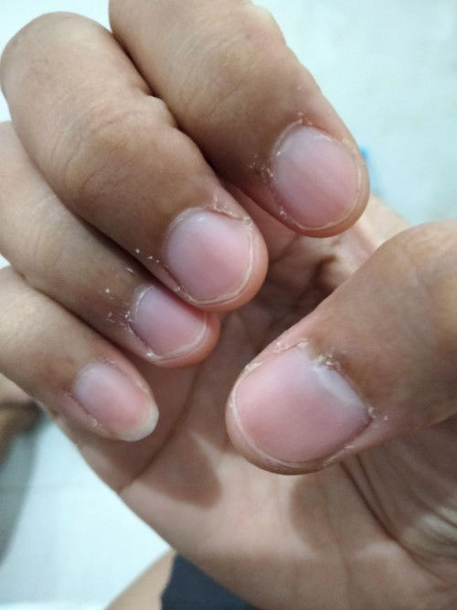 Pinggiran kuku kering mengelupas