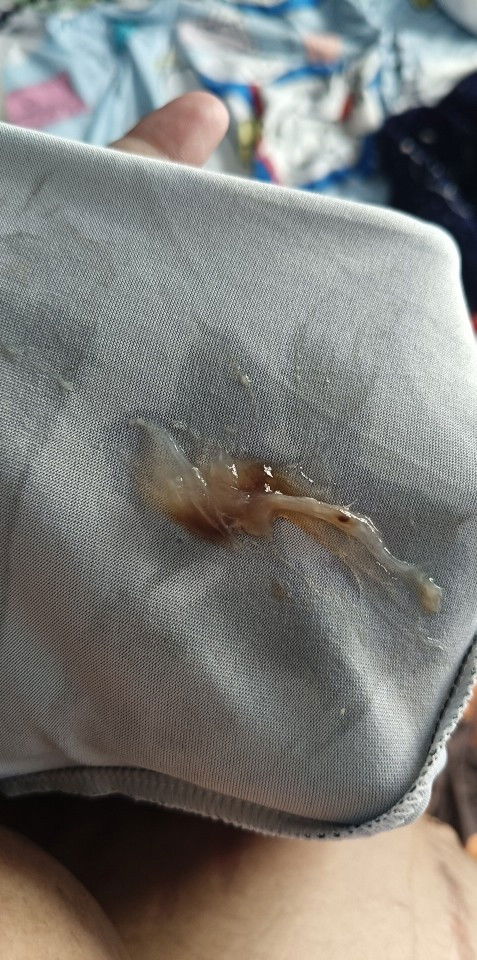 มีมูกออกมาแบบนี้ปกติไหมคะ
ตั้งครรภ์ 36+5ค่ะ