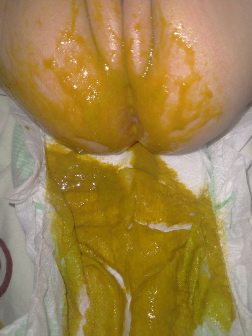 Watery poop formula feed baby