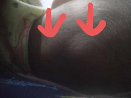 Benjolan di kepala belakang