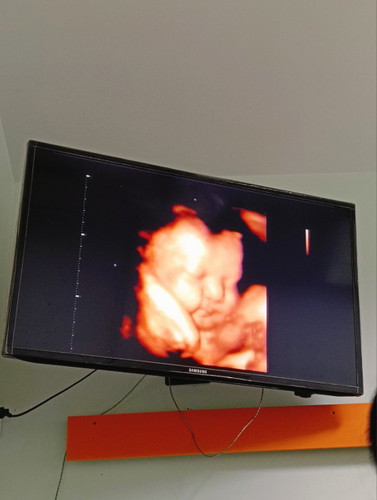 33week+4วัน อยากทราบว่าลูกกลับหัวหรือยัง.