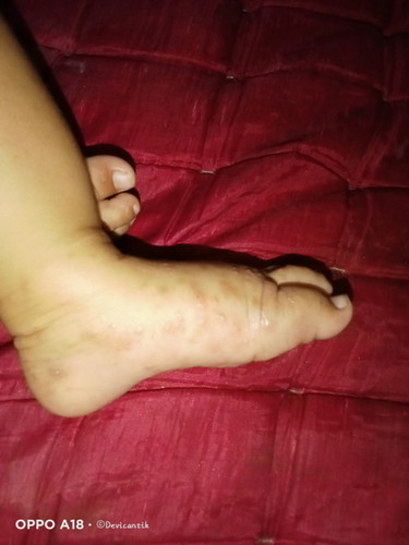 Mau nanya dong bun ini kaki anak aku kenapa ya bintik" berair apa ada yg sama trus dkasih apa?