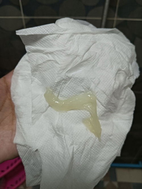 ขอถามแม่ๆที่มีประสบการณ์หน่อยค่ะ พอดีหนูปวดท้องแบบนี้ มีมุกออกมาด้วยแต่ไม่มีเลือด