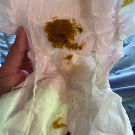 คลอดน้องได้5วันเเล้ว