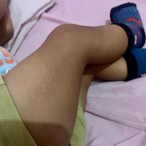 Kaki dan tangan banyak sel kulit mati