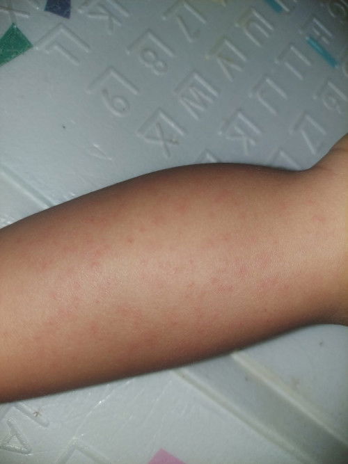 Roseola/campak/ruam setelah demam?