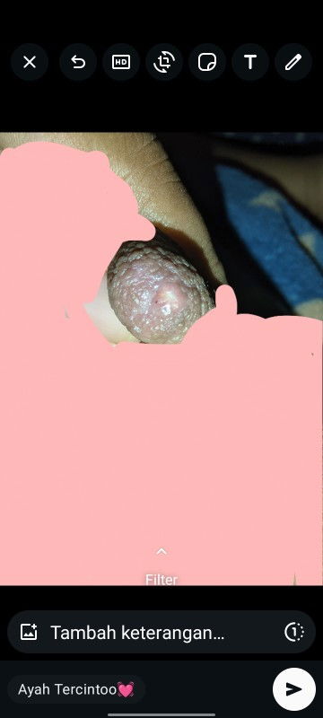 Penyumbatan payudara