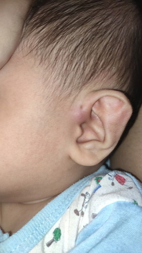 Telinga bengkak (Preauricular)