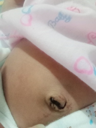 สะดือน้องหลุดวันนี้ แต่มีเลือดออด ปกติใมค่ะ