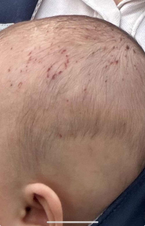 Anak garu kepala sampai berbintik macam kena tembak askar🥲