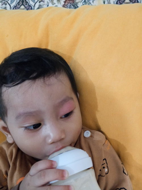 Kene gigit nyamuk kat mata sampai bengkak