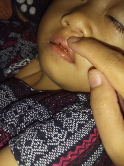 Bibir anak kering dan sampai luka