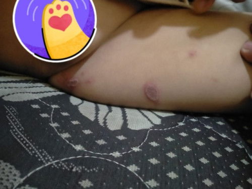 Luka /koreng pada anak 2 tahun 10 bulan