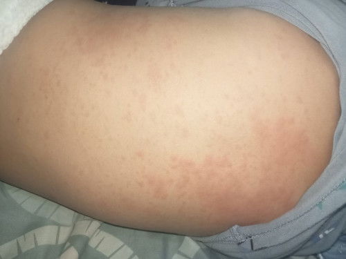 น้องผื่นแดงหลังหายไข้