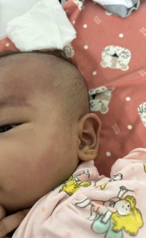 Biang keringat atau alergi