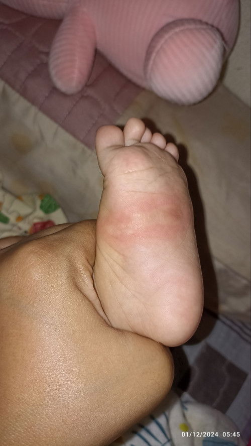 Ini insect bite atau allergic?
