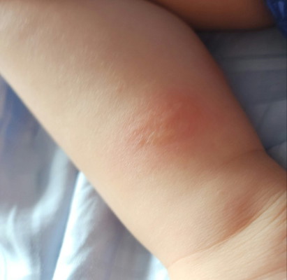 Hi Mummies, anyone experience these patches on babies leg?