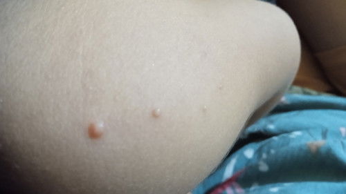 Benjolan seperti kutil