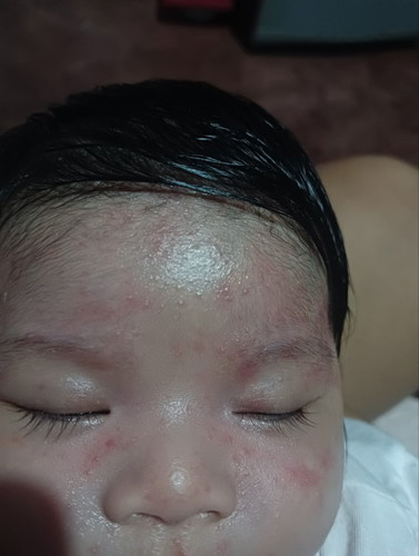 Ask ko lang po ano po ba to? At pano po to maiiwasan at anong pwedeng gawin para mawala agad ito?