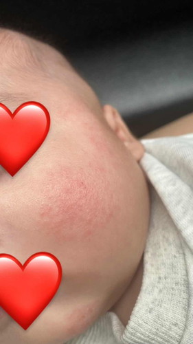 It’s been there for a month… some days getting better some days getting worser… Help!