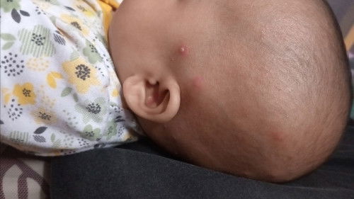 Bentol merah bernanah