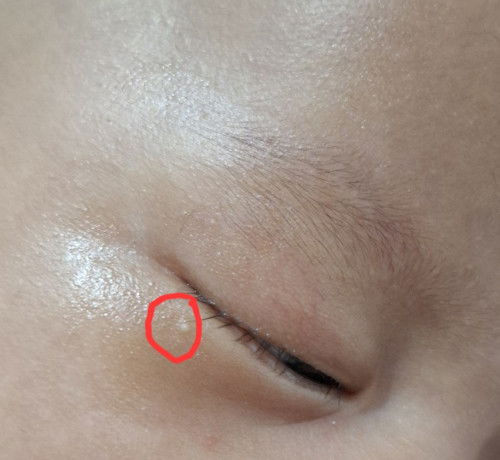 Bintik putih di bawah mata bayi