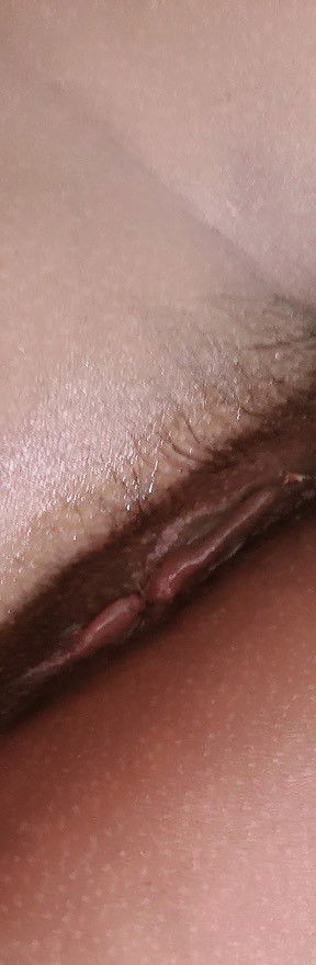 Keloid sa bandang pwet