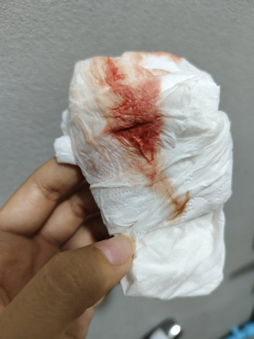 มีเลือดออกระหว่างตั้งครรภ์​