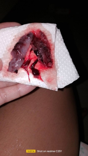 6 week's pregnant  Bleeding😭