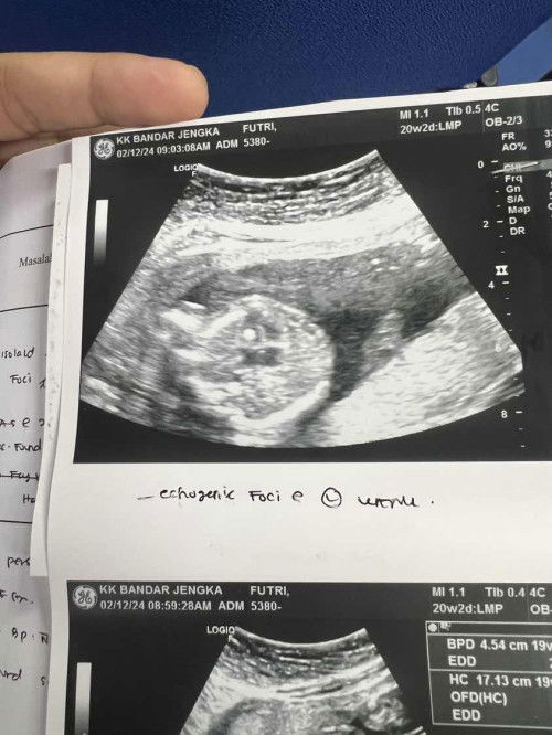 Tanda putih pada jantung baby