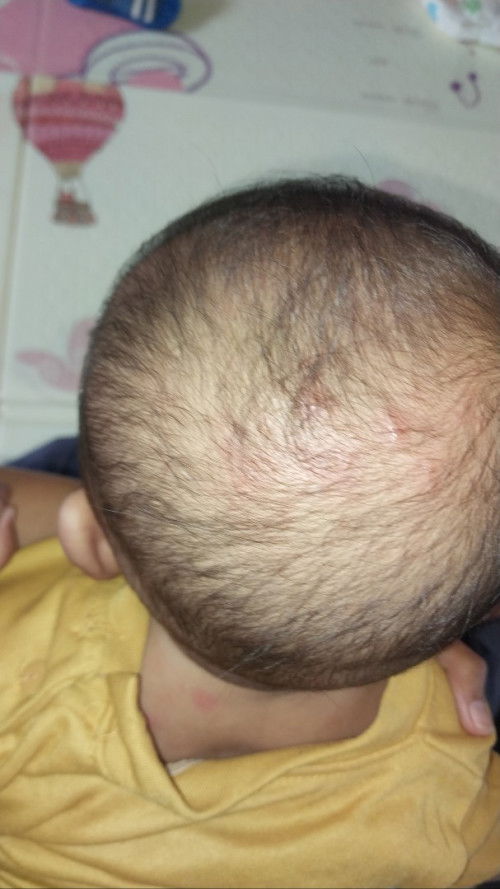 Ada benjol kecil2 seperti bisul