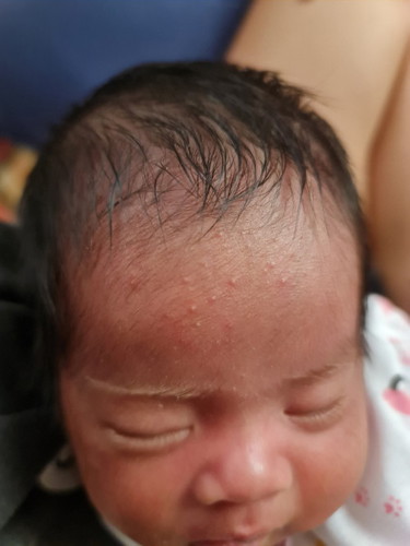 ลูกอายุไม่ถึงเดือน เป็นผดผื่นขึ้นแบบนี้พอมีวิธีรักษาไหมคะ