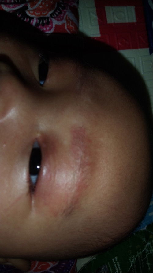 Bayi 2 bulan kelopak mata merah