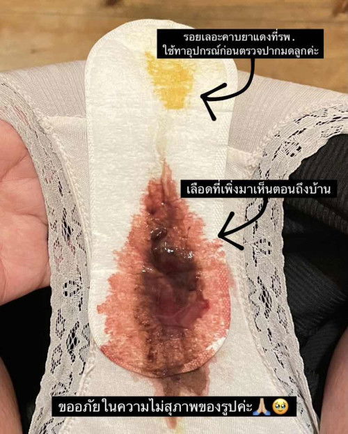 39+1 เลือดออกเยอะไปไหมคะ แบบนี้ใกล้คลอดแล้วรึเปล่าคะ