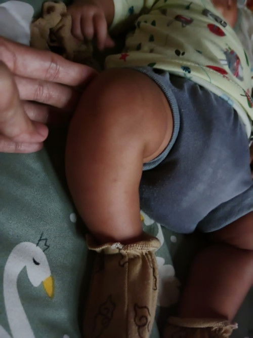Kaki bengkok bayi 2bln 10hari