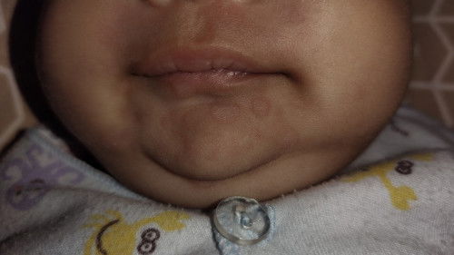 Bund cara nyembuhin ringworm spt ini pake apa yaa😭