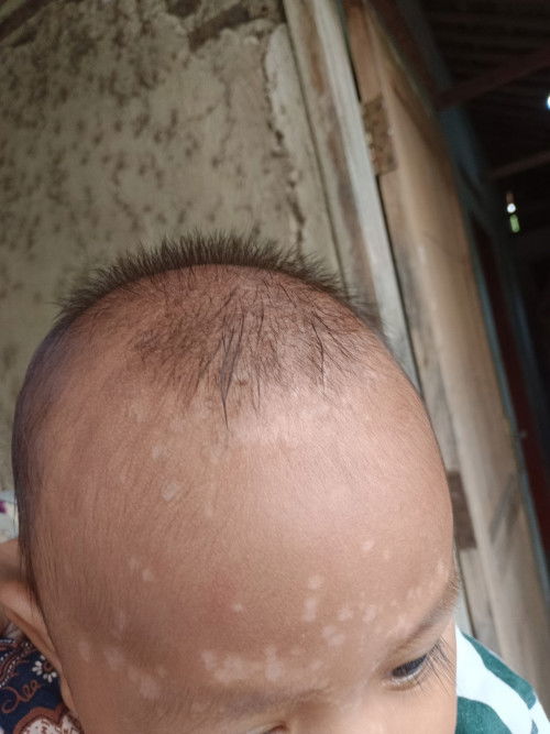 Bercak putih anak