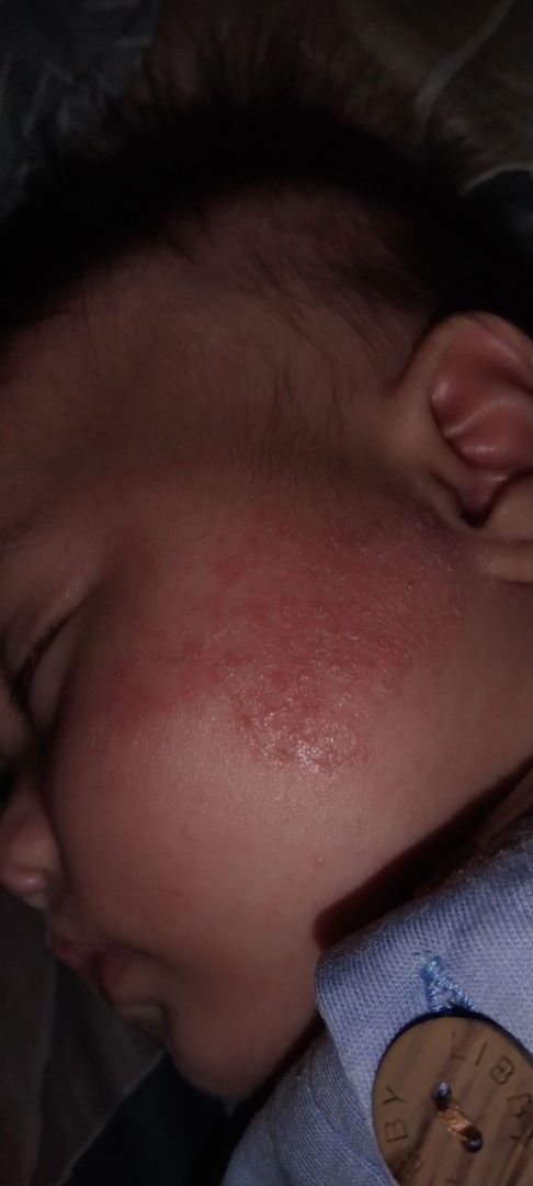 Bun, ada ngak dsni sma dengan anakku dan mukanya kaya d foto awalnya merahnya cmn kecil lama2