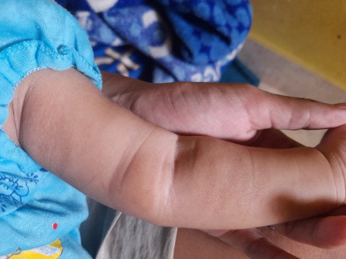 Siku lutut bayi kering