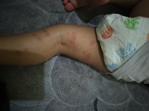 Kenapa anaku merah-merah gini yaa.. tangan dan kakinyaa.. bukan bentol, beberapa ke muka juga