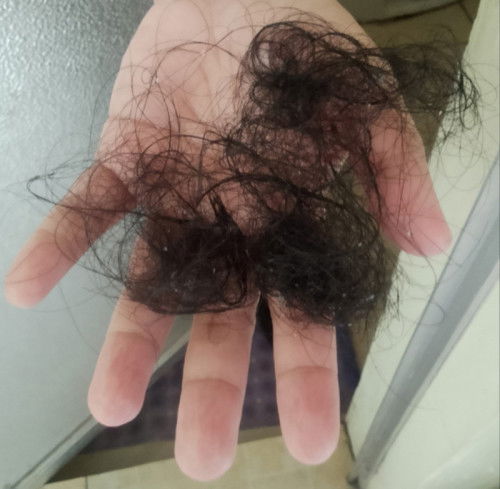 HAIRFALL 1 yr after birth