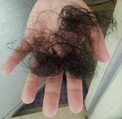 HAIRFALL 1 yr after birth