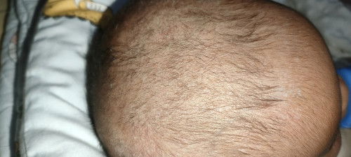 Cara ngilangin kerak kering dikulit kepala bayi