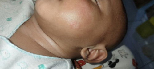 Kulit pipi bayi berutusan dan kaya jamur