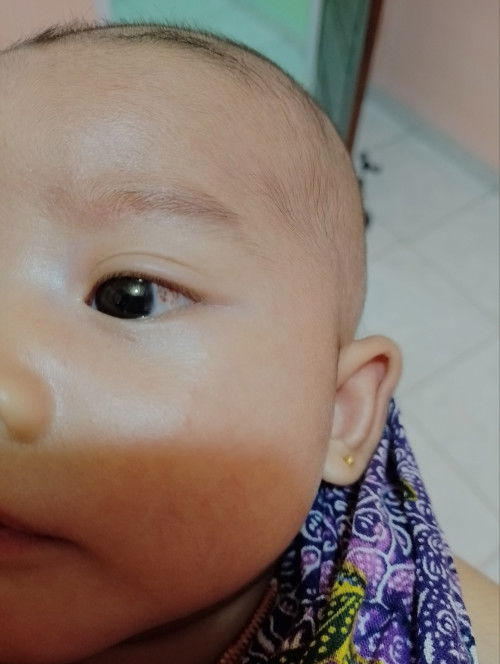 Merah di mata bayi
