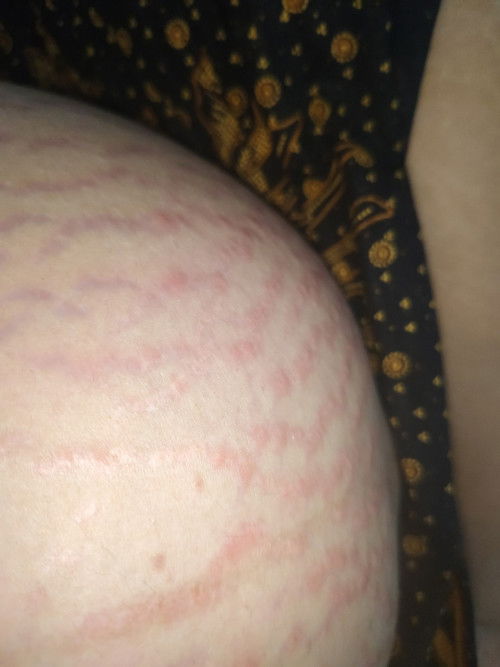 Gatal Stretchmark sperti bentol di setiap garis nya