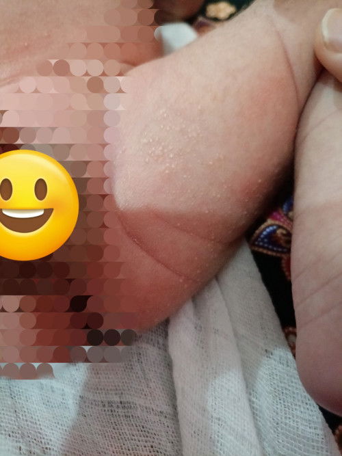 Suggest cream untuk ruam macam dalam gambar dibawh