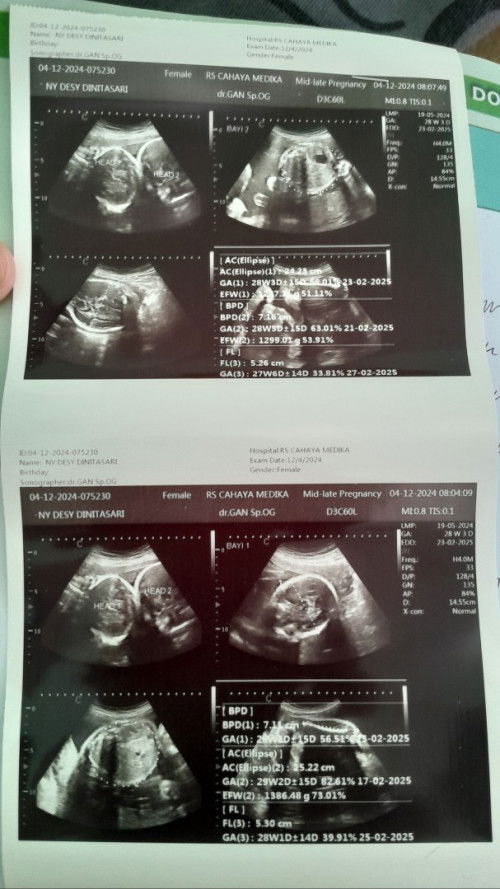 Hamil Gemelli (hamil kembar)